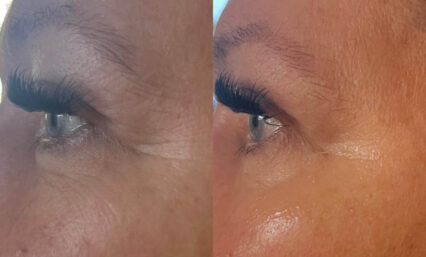 Kollageenisilkkilankakohotus2 www.eiraestetica.fi kollageenisilkkilankakohotus2 kollageenisilkkilankakohotus2