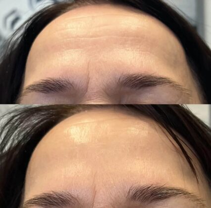 Kollageenisilkkilankakohotus1 www.eiraestetica.fi kollageenisilkkilankakohotus1 kollageenisilkkilankakohotus1